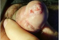 尖锐湿疣怎么治疗？尖锐湿疣的饮食治疗方法